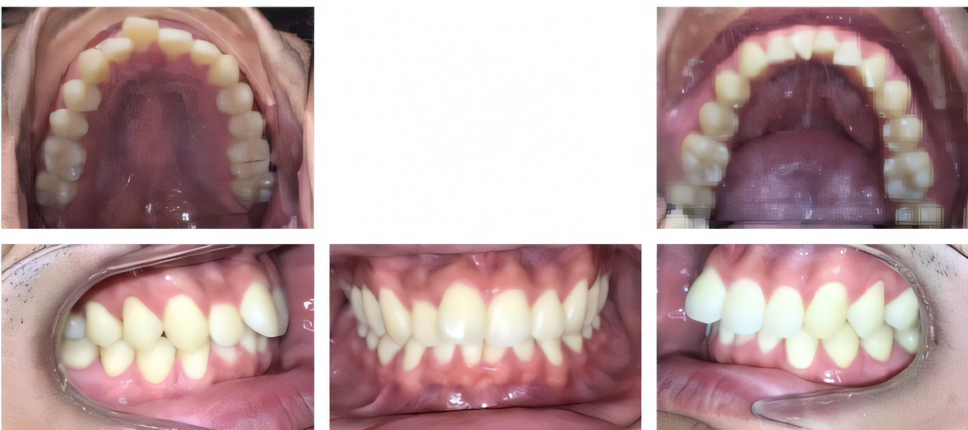 Invisalign for teens before